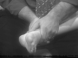 Talocalcaneal Inversion Subluxation